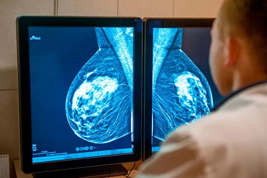 El CBD inhibe una vía clave en cáncer de mama agresivo