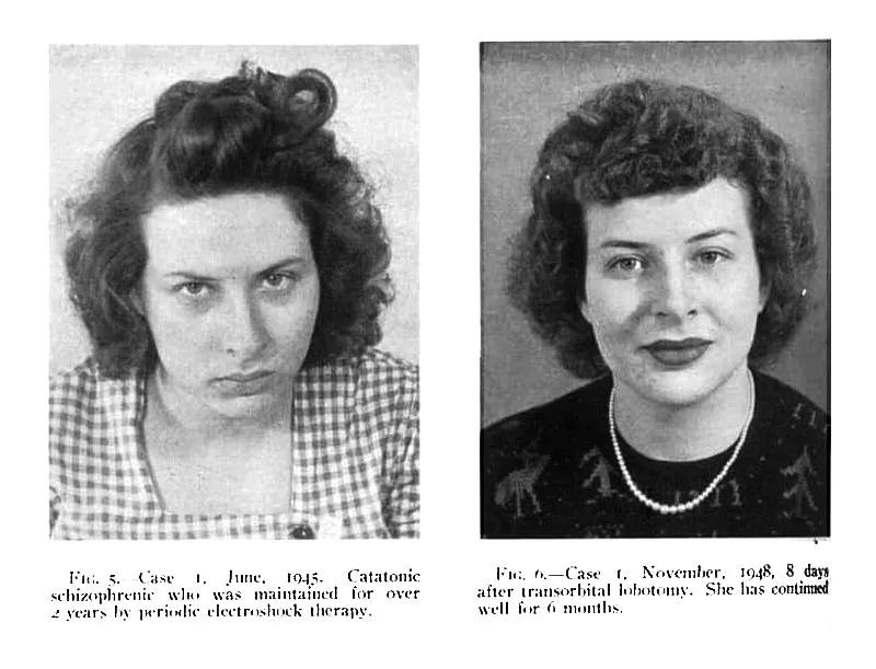 El antes y el después de una lobotomía transorbital a una catatónica esquizofrénica. Comparativas propagandísticas como esta ayudaron a la expansión de las operaciones de Freeman.